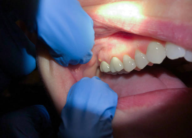 Best Emergency Wisdom Teeth Removal in San Joaquin, CA